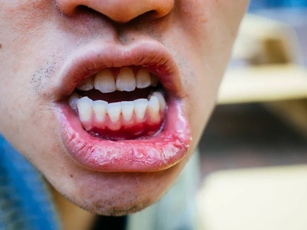 Dry mouth and bad teeth of a man on cold day close up