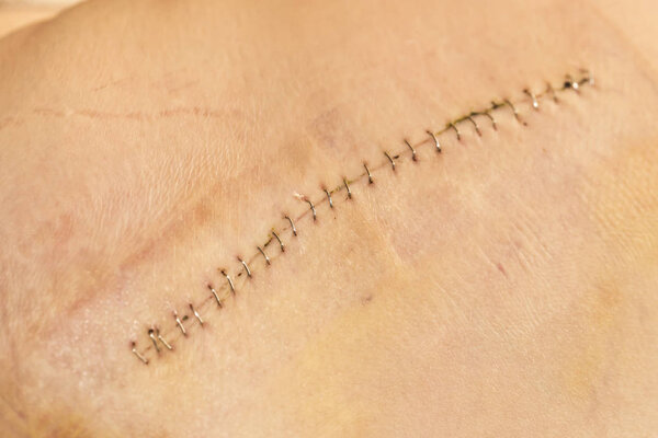 рана на коже
