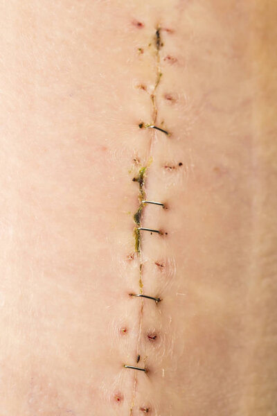 рана на коже
