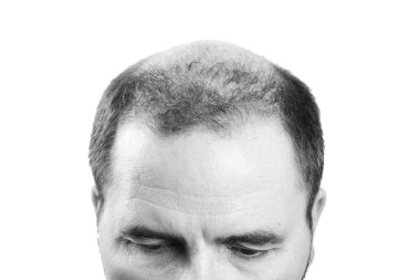 Orta yaşlı adam tarafından saç dökülmesi kellik saç dökülmesi siyah ve beyaz ilgili.
