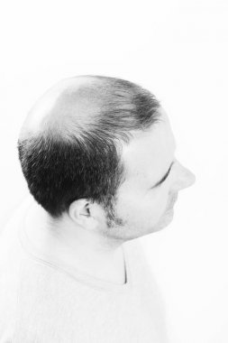 Orta yaşlı adam tarafından saç dökülmesi kellik saç dökülmesi siyah ve beyaz ilgili.