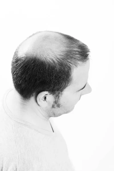 Middle-aged man concerned by hair loss Baldness alopecia Black and white — Stock Photo, Image