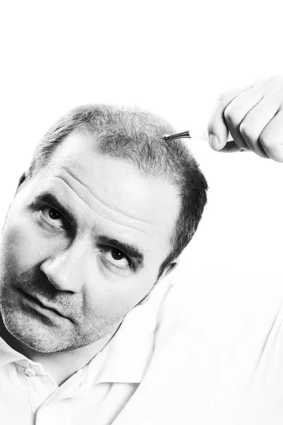 Hombre de mediana edad preocupado por la pérdida de cabello Calvicie alopecia Blanco y negro — Foto de Stock