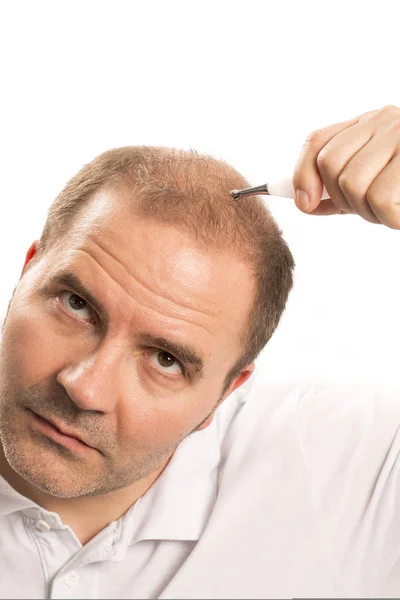 Man van middelbare leeftijd verontrust over haarverlies kaalheid alopecia zwart-wit — Stockfoto