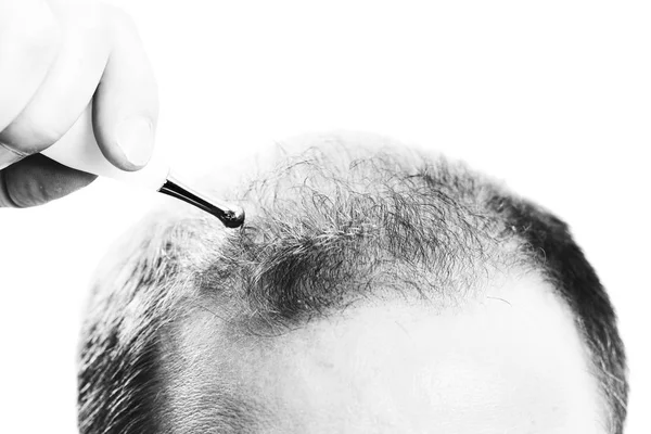 Hombre de mediana edad preocupado por la pérdida de cabello Calvicie alopecia Blanco y negro —  Fotos de Stock