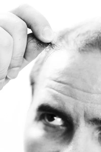 Homem de meia-idade preocupado com a perda de cabelo Calvície alopecia Preto e branco — Fotografia de Stock
