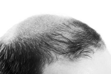 Orta yaşlı adam izole kellik saç dökülmesi saç dökülmesi ile ilgili