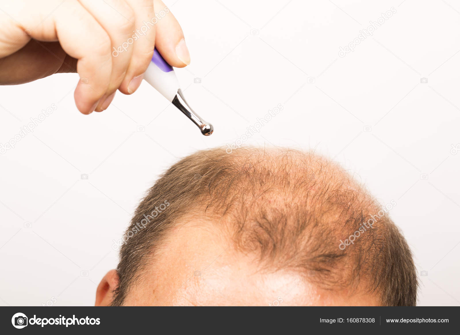 андрогенетическая алопеция трихоскопия. алопеция психосоматика у женщин. врач по волосам на голове. проктология заболевания. для роста волос.