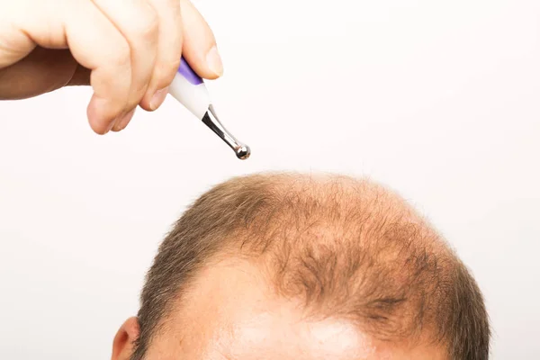 Hombre de mediana edad preocupado por la pérdida de cabello Calvicie alopecia primer plano fondo blanco —  Fotos de Stock