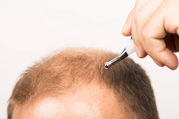 Homem de meia-idade preocupado com a perda de cabelo Calvície alopecia close up fundo branco — Fotografia de Stock