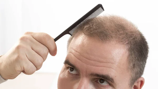 Mann mittleren Alters besorgt über Haarausfall Haarausfall Alopezie Nahaufnahme weißen Hintergrund — Stockfoto