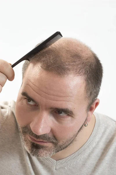 Middle-aged man concerned by hair loss Baldness alopecia close up white background — Stock Photo, Image