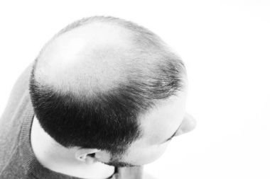 Orta yaşlı adam saç dökülmesi kellik saç dökülmesi ile ilgili yakın siyah ve beyaz, beyaz arka plan