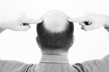 Orta yaşlı adam saç dökülmesi kellik saç dökülmesi ile ilgili yakın siyah ve beyaz, beyaz arka plan