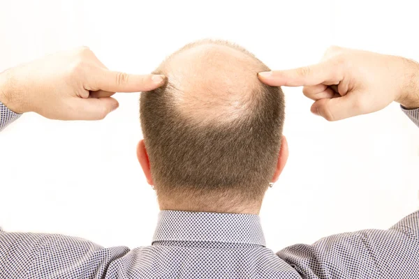 Мужчина средних лет обеспокоен потерей волос облысение алопеция закрыть белый фон — стоковое фото
