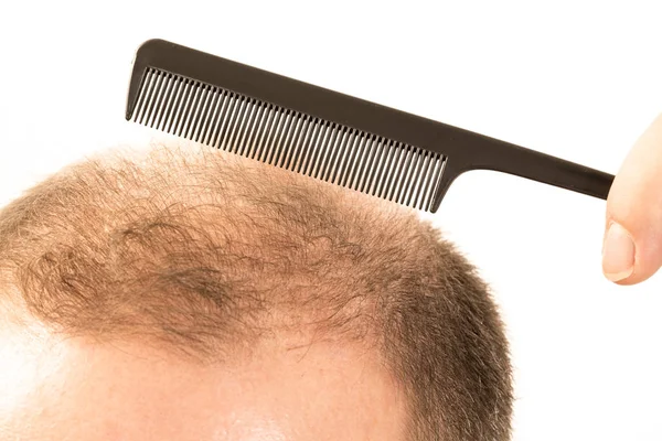 Hombre de mediana edad preocupado por la pérdida de cabello Calvicie alopecia primer plano fondo blanco —  Fotos de Stock