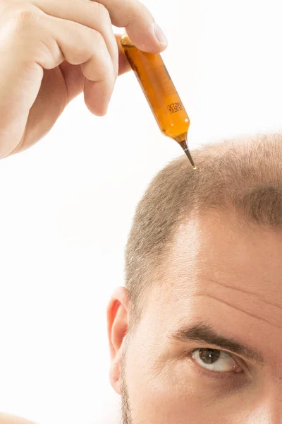 Hombre de mediana edad preocupado por la pérdida de cabello Calvicie alopecia primer plano fondo blanco — Foto de Stock