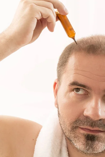 Homme d'âge moyen concerné par la perte de cheveux Calvitie alopécie gros plan fond blanc — Photo