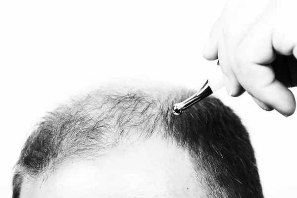 Homme d'âge moyen concerné par la perte de cheveux Calvitie alopécie gros plan noir et blanc, fond blanc — Photo