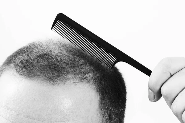 Hombre de mediana edad preocupado por la pérdida de cabello alopecia calvicie primer plano blanco y negro, fondo blanco —  Fotos de Stock