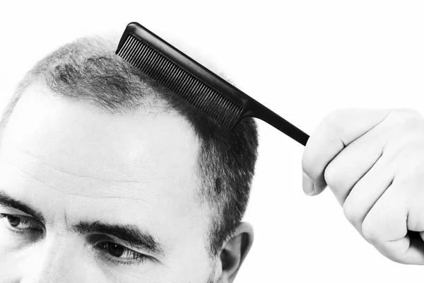 Homme d'âge moyen concerné par la perte de cheveux Calvitie alopécie gros plan noir et blanc, fond blanc — Photo