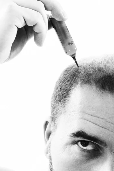 Homme d'âge moyen concerné par la perte de cheveux Calvitie alopécie gros plan noir et blanc, fond blanc — Photo