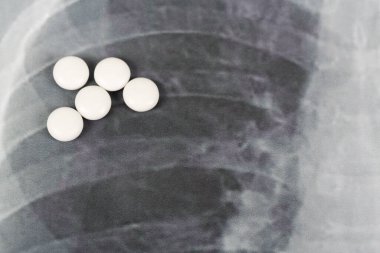 Roman Covid-19, Coronavirus. Enfekte olmuş akciğerler radyoloji mavi görüntü arka planı, üzerinde beyaz klorokin hapları var..