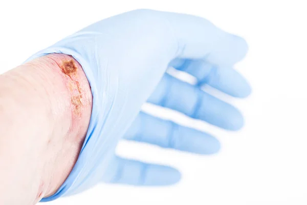 用氢氧化钠酸对腕部皮肤进行化学烧伤 用木片涂刷 火热和深深的伤口 家庭事故 因为蓝色手套锋利 有选择的重点 — 图库照片