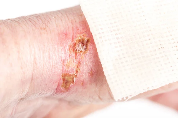 Brûlure Chimique Sur Peau Poignet Avec Hydroxyde Sodium Acide Blessure — Photo