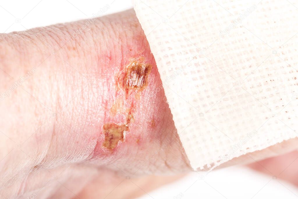 chemical burn on the wrist skin with hydroxide sodium acid. Festering and deep wound. Household accident, because of blue gloves to sharp. Sterile paraffin gauze dressing on it. Selective focus