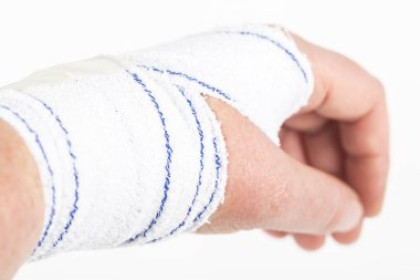 chemical burn on the wrist skin with hydroxide sodium acid. Festering and deep wound. Household accident, because of blue gloves to sharp. Medical bandage on it. Selective focus clipart