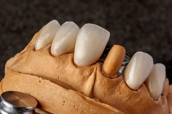 Zahnimplantat. Wiederherstellung der Zähne. Zahnarzt. Dentallabor — Stockfoto