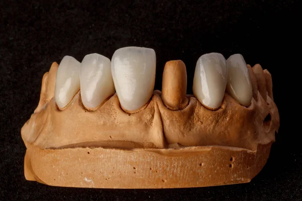 Ett tandimplantat. Restaurering av tänderna. Tandläkare. Tandvårdslabb — Stockfoto