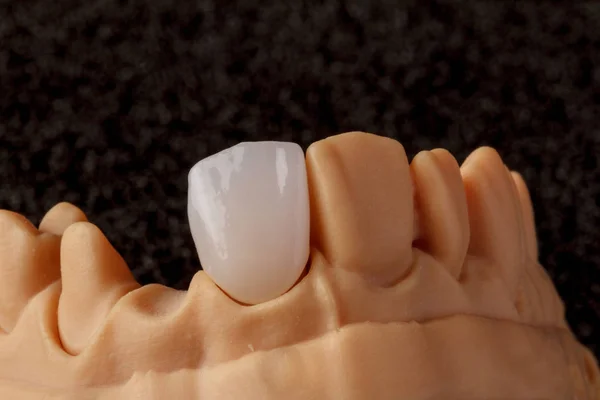 Zahnimplantat. Wiederherstellung der Zähne. Zahnarzt. Dentallabor — Stockfoto