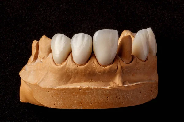 Ett tandimplantat. Restaurering av tänderna. Tandläkare. Tandvårdslabb — Stockfoto