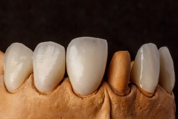 Implante dental. Restauración de dientes. Cirujano dental Laboratorio dental — Foto de Stock