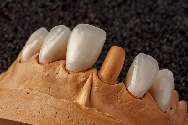 Implante Dental Restauración Dientes Cirujano Dental Laboratorio Dental Clínica Dental — Foto de Stock