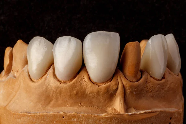 Implante Dental Restauración Dientes Cirujano Dental Laboratorio Dental Clínica Dental — Foto de Stock