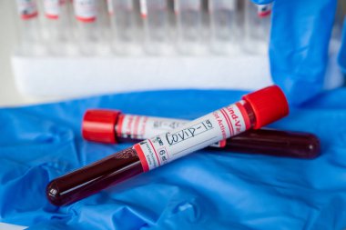 Wuhan 'dan yeni Corona virüsü enfeksiyonu teşhisi için pozitif COVID-19 testi ve laboratuvar örneği. Bulaşıcı salgın konsepti