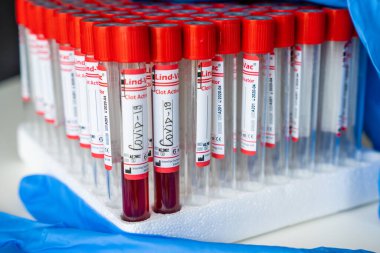 Wuhan 'dan gelen yeni Corona virüsü enfeksiyonunun teşhisi için COVID-19 testi ve laboratuvar örneği. Bulaşıcı salgın konsepti