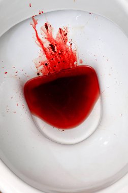 Beyaz seramik klozet kan lekeli. Belirgin adet, dysbacteriosis, dizanteri, basur, kanser ve diğer hastalıkları benzer semptomlarla birlikte sonuçları