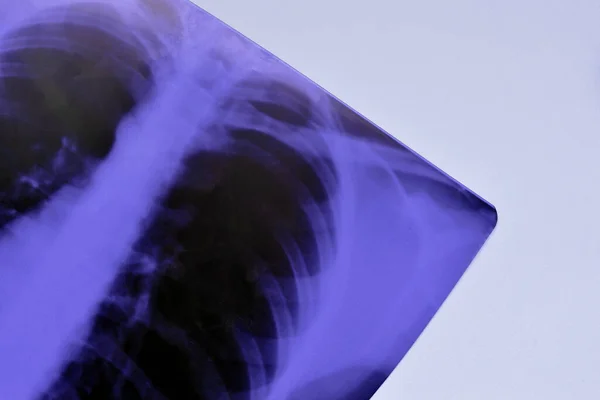 Εικόνα Του Ανθρώπινου Στήθους Ακτινογραφία Για Ιατρική Διάγνωση Στο Μπλε — Φωτογραφία Αρχείου