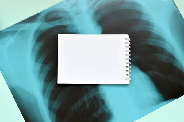Röntgenfelvétel Emberi Mellkasról Orvosi Diagnózishoz Üres Jegyzetfüzet Kék Kórházi Asztalon — Stock Fotó