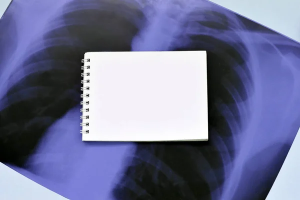 Εικόνα Του Ανθρώπινου Στήθους Ακτινογραφία Για Ιατρική Διάγνωση Και Κενό — Φωτογραφία Αρχείου