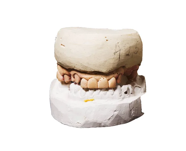 Μια μερική οδοντοστοιχία τοποθετείται σε ένα μοντέλο μελέτη σοβά — Φωτογραφία Αρχείου