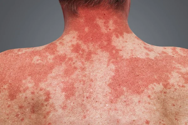 Алергія шкіри на людське тіло . — стокове фото