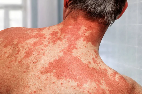 Алергія шкіри на людське тіло. хвороби шкіри . — стокове фото