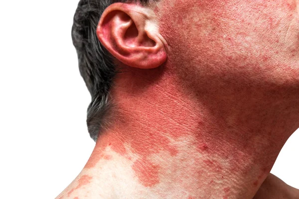 Алергія шкіри на людське тіло. хвороби шкіри — стокове фото