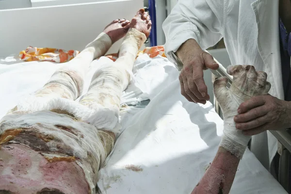 Hastanede yanıkları olan bir adam, bir hemşirenin elleri..