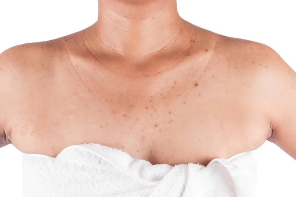 Acne on body skin on white background — Stock Photo, Image